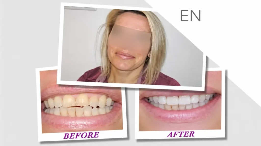 dental implants hungary helvetic clinics