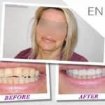 dental implants hungary helvetic clinics